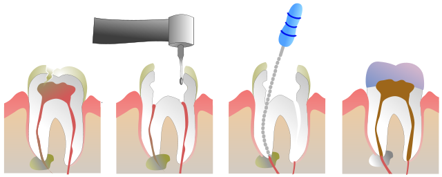 640px-Root_Canal_Illustration_Molar.svg
