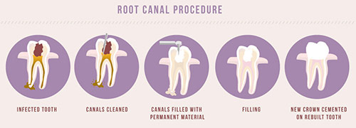 What-is-a-Tooth-Abscess02