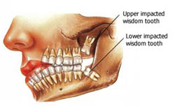 Fun Facts About Wisdom Teeth