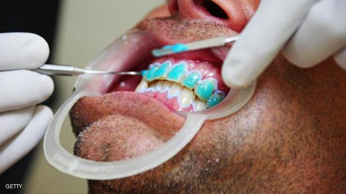utah teeth whitening photo