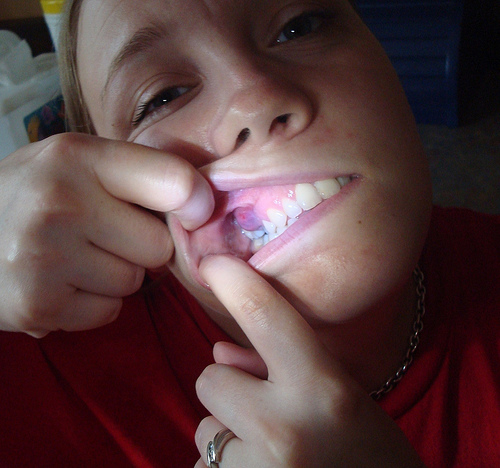 dental abscess photo