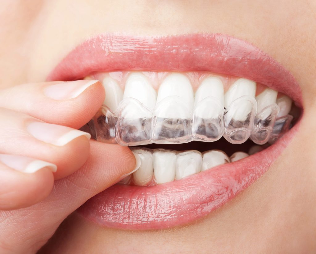 in-office-whitening-treatment